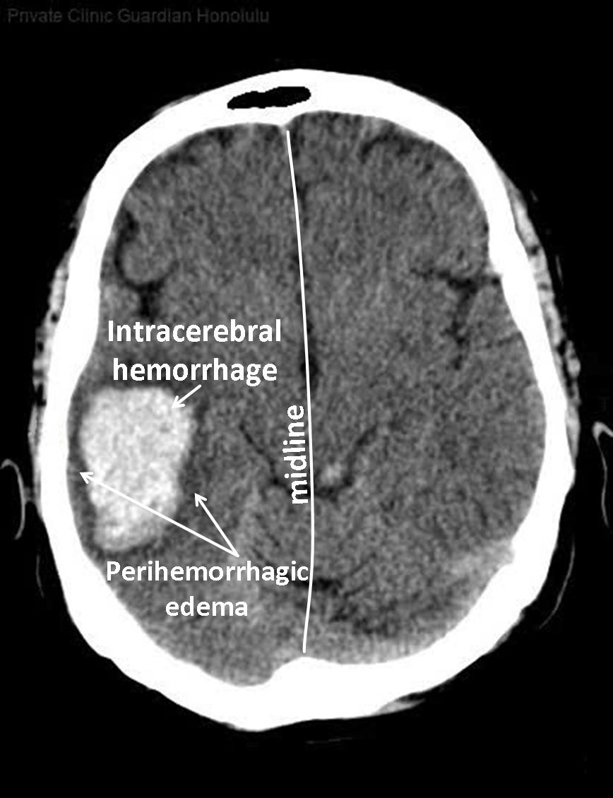 Intracerebral Hemorrhage Ct Novel Imaging Model Of Basal Ganglia ICH Intracerebral Hemorrhage Ct Novel Imaging Model Of Basal Ganglia ICH